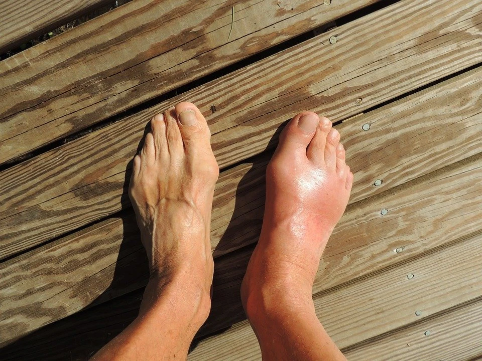 uric acid and gout 