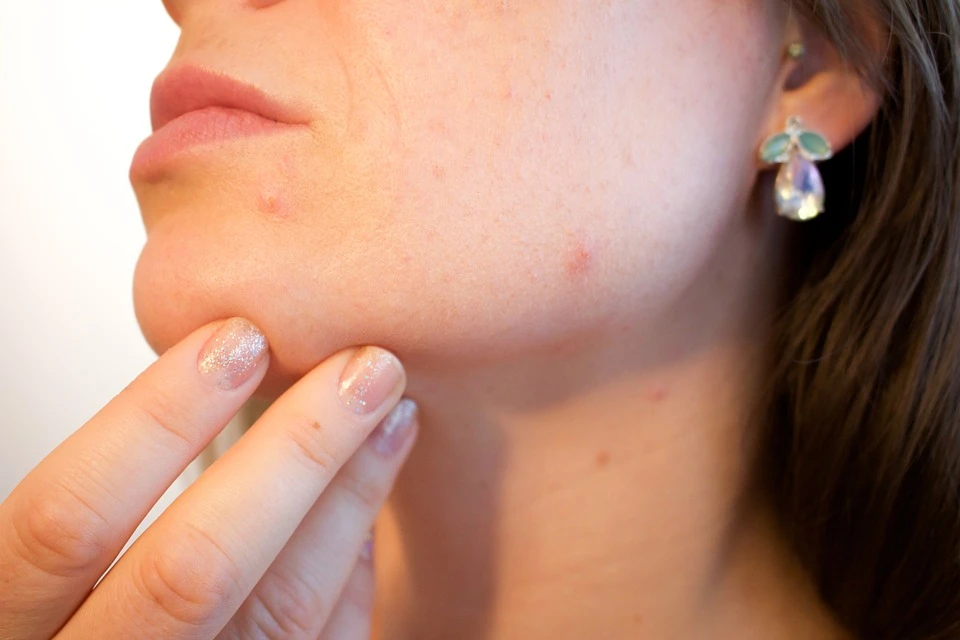 fenugreek helps to fight acne