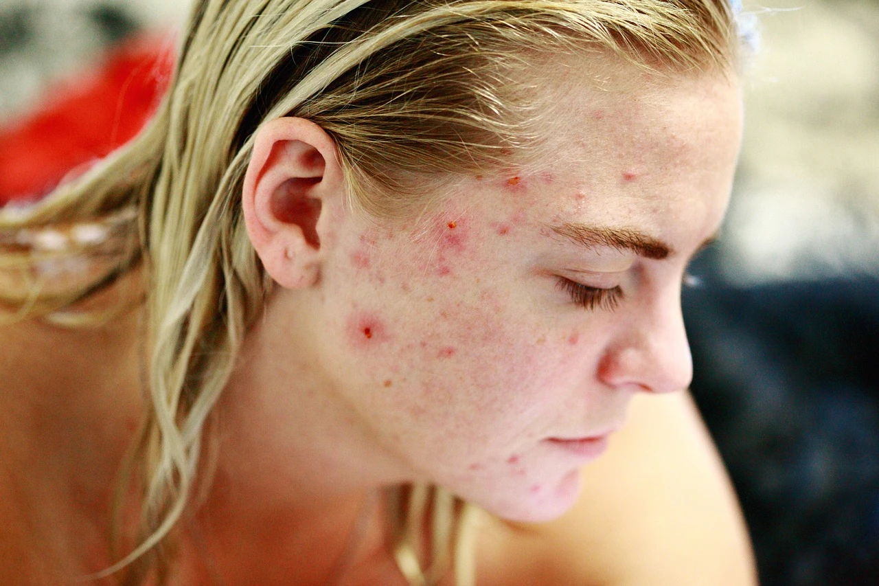 skin acne of pcos patient